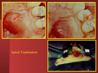 Apical Trephination 
 