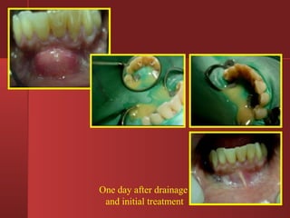One day after drainage 
and initial treatment 
 