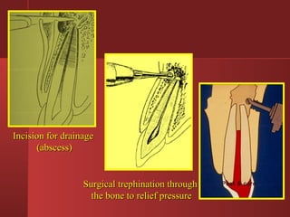 IInncciissiioonn ffoorr ddrraaiinnaaggee 
((aabbsscceessss)) 
SSuurrggiiccaall ttrreepphhiinnaattiioonn tthhrroouugghh 
tthhee bboonnee ttoo rreelliieeff pprreessssuurree 
Post & core 
 