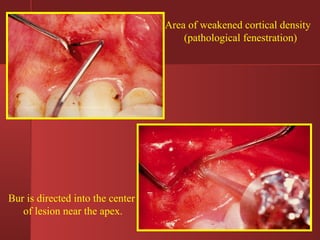 Area of weakened cortical density 
(pathological fenestration) 
Bur is directed into the center 
of lesion near the apex. 
 