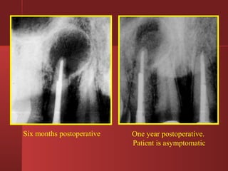Six months postoperative One year postoperative. 
Patient is asymptomatic 
 