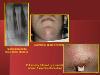 Trauma followed by 
acute apical abscess 
Submental space swelling 
Pulpectomy followed by extraoral 
incision & placement of a drain 
 