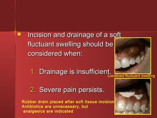  IInncciissiioonn aanndd ddrraaiinnaaggee ooff aa ssoofftt 
fflluuccttuuaanntt sswweelllliinngg sshhoouulldd bbee 
ccoonnssiiddeerreedd wwhheenn:: 
11.. DDrraaiinnaaggee iiss iinnssuuffffiicciieenntt.. 
22.. SSeevveerree ppaaiinn ppeerrssiissttss.. 
Localized fluctuant swelling 
Rubber drain placed after soft tissue incision. 
Antibiotics are unnecessary, but 
analgesics are indicated 
 