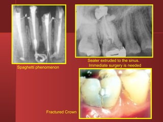 Spaghetti phenomenon 
Sealer extruded to the sinus. 
Immediate surgery is needed 
Fractured Crown 
 