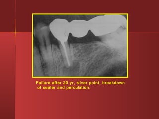 Failure after 20 yr, silver point, breakdown 
of sealer and perculation. 
 