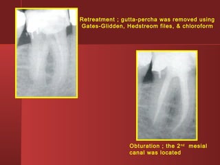 Retreatment ; gutta-percha was removed using 
Gates-Glidden, Hedstreom files, & chloroform 
Obturation ; the 2nd mesial 
canal was located 
 