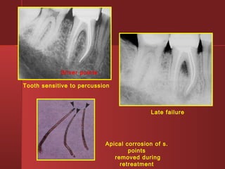 Apical corrosion of s. 
points 
removed during 
retreatment 
Tooth sensitive to percussion 
Late failure 
Silver points 
 