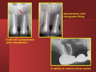 In ability to remove silver points 
Tooth still symptomatic 
after retreatment 
Apicoectomy with 
retrograde filling 
 