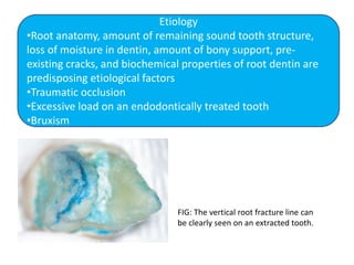 Etiology
•Root anatomy, amount of remaining sound tooth structure,
loss of moisture in dentin, amount of bony support, pre-
existing cracks, and biochemical properties of root dentin are
predisposing etiological factors
•Traumatic occlusion
•Excessive load on an endodontically treated tooth
•Bruxism
FIG: The vertical root fracture line can
be clearly seen on an extracted tooth.
 