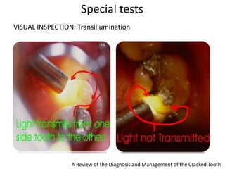 VISUAL INSPECTION: Transillumination
Special tests
A Review of the Diagnosis and Management of the Cracked Tooth
 