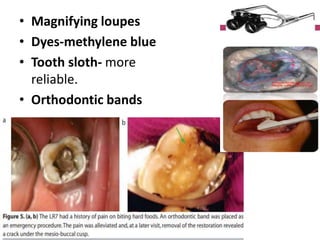 • Magnifying loupes
• Dyes-methylene blue
• Tooth sloth- more
reliable.
• Orthodontic bands
 