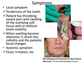 Symptoms
• Local symptom
Tenderness of the tooth.
Patient has throbbing
severe pain with swelling
of the overlying soft
tissue with or without
tooth mobility.
When swelling become
extensive, it result into
cellulitis and the patients
facial changes.
• Systemic symptom
Fever, Irritation, etc
Microbiology and Treatment of Acute Apical
Abscesses : Clinical Microbiology Reviews
 