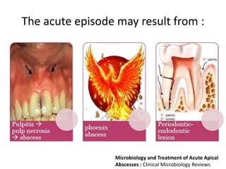 The acute episode may result from :
Microbiology and Treatment of Acute Apical
Abscesses : Clinical Microbiology Reviews
 