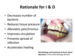 Rationale for I & D
• Decreases number of
bacteria
• Reduces tissue pressure
• Alleviates pain/trismus
• Improves circulation
• Prevents spread of
infection
• Accelerates healing
Microbiology and Treatment of Acute Apical
Abscesses : Clinical Microbiology Reviews
 