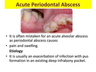 Acute Periodontal Abscess
• It is often mistaken for an acute alveolar abscess
as periodontal abscess causes
• pain and swelling.
Etiology
• It is usually an exacerbation of infection with pus
formation in an existing deep infrabony pocket.
 