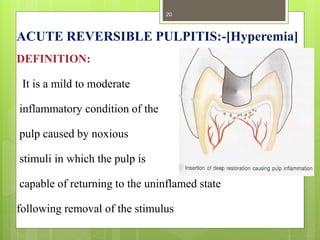 ACUTE REVERSIBLE PULPITIS:-[Hyperemia]
DEFINITION:
It is a mild to moderate
inflammatory condition of the
pulp caused by noxious
stimuli in which the pulp is
capable of returning to the uninflamed state
following removal of the stimulus
20
 