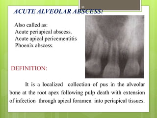 ACUTE ALVEOLAR ABSCESS:
Also called as:
Acute periapical abscess.
Acute apical pericementitis
Phoenix abscess.
DEFINITION:
It is a localized collection of pus in the alveolar
bone at the root apex following pulp death with extension
of infection through apical foramen into periapical tissues.
36
 