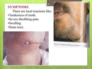 SYMPTOMS
There are local reactions like:
•Tenderness of tooth.
•Severe throbbing pain.
•Swelling.
•Sinus tract.
39
 