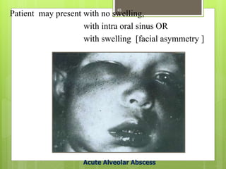 Acute Alveolar Abscess
Patient may present with no swelling,
with intra oral sinus OR
with swelling [facial asymmetry ]
45
 