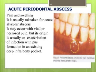 ACUTE PERIODONTAL ABSCESS
Pain and swelling
It is usually mistaken for acute
alveolar abscess
It may occur with vital or
necrosed pulp, but its origin
is usually an exacerbation
of infection with pus
formation in an existing
deep infra bony pocket.
49
 