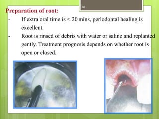 Preparation of root:
- If extra oral time is < 20 mins, periodontal healing is
excellent.
- Root is rinsed of debris with water or saline and replanted
gently. Treatment prognosis depends on whether root is
open or closed.
83
 