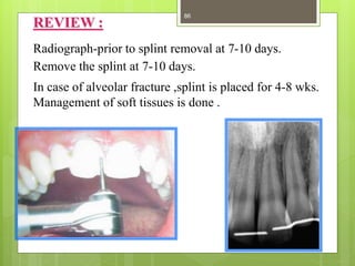 REVIEW :
Radiograph-prior to splint removal at 7-10 days.
Remove the splint at 7-10 days.
In case of alveolar fracture ,splint is placed for 4-8 wks.
Management of soft tissues is done .
86
 