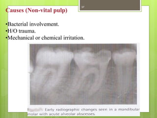 Causes (Non-vital pulp)
•Bacterial involvement.
•H/O trauma.
•Mechanical or chemical irritation.
37
 