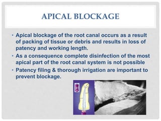 Endodontic Errors | PPTX
