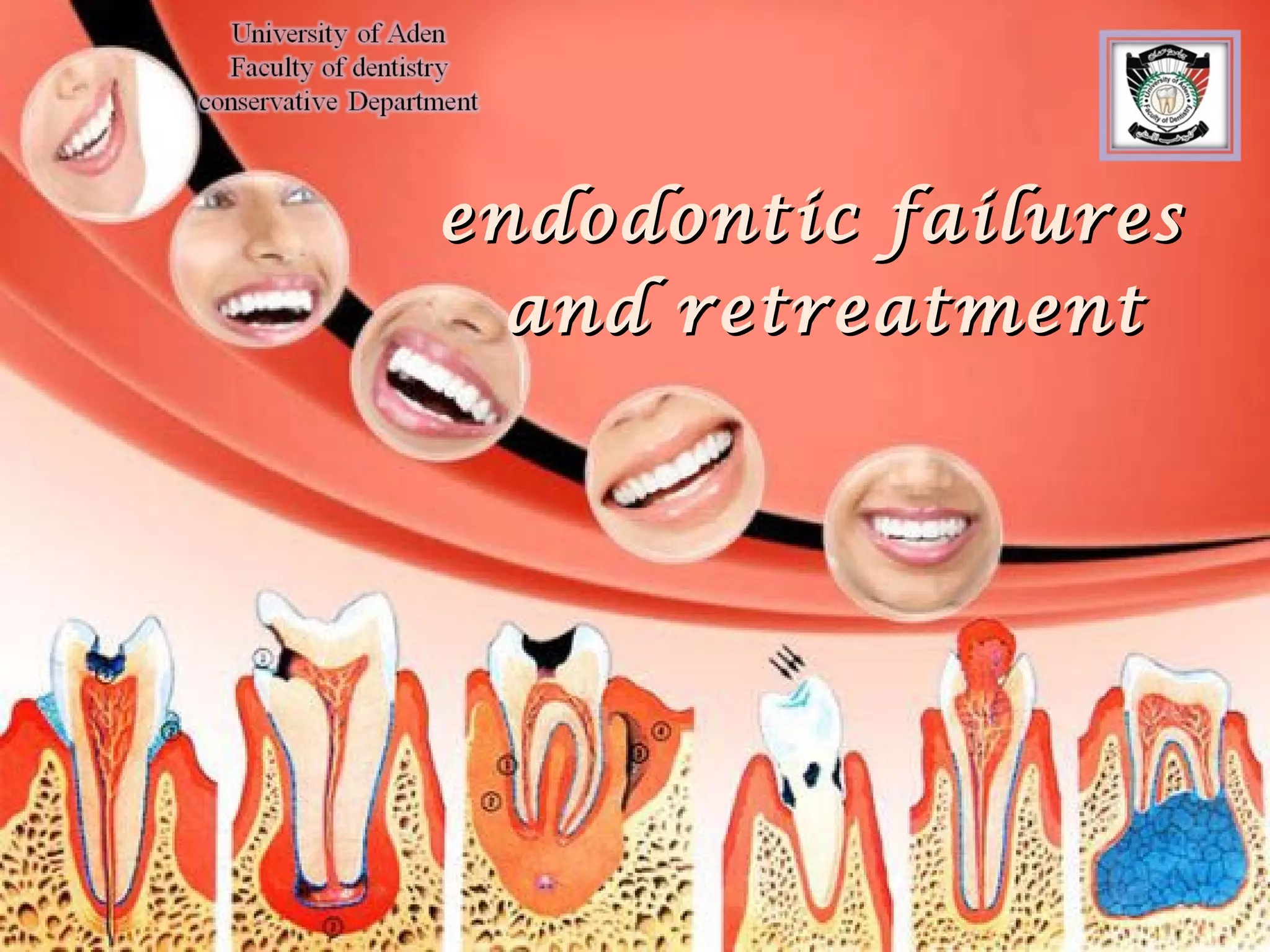 Endodontic failures PPT