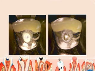 Endodontic failures | PPT