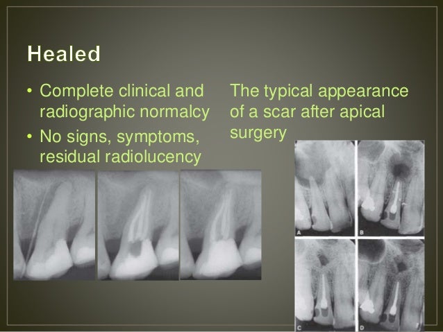 endodontic failures apical scar