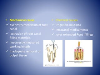• Mechanical cause
 overinstrumentation of root
canal
 extrusion of root canal
filling materials
 incorrectly measured
working length
 Inadequate removal of
pulpal tissue
• Chemical causes
 Irrigation solutions
 Intracanal medicaments
 over extended Root fillings
 