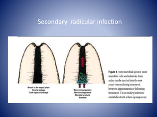 Secondary radicular infection
 