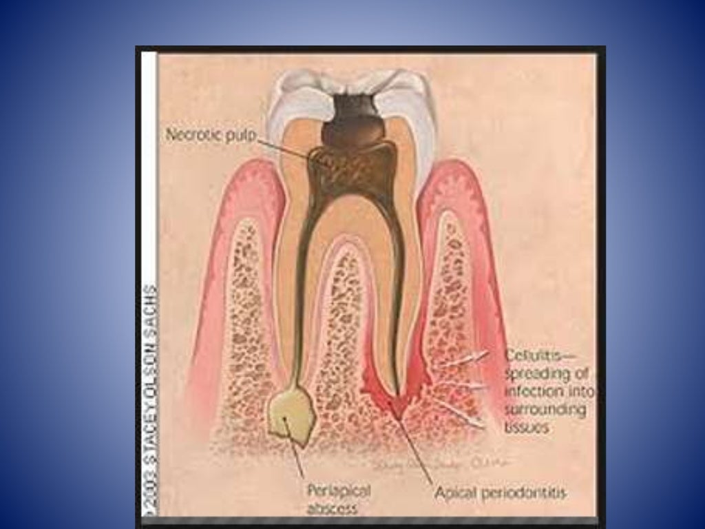 Endodontic flareup