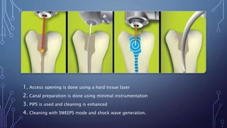 1. Access opening is done using a hard tissue laser
2. Canal preparation is done using minimal instrumentation
3. PIPS is used and cleaning is enhanced
4. Cleaning with SWEEPS mode and shock wave generation.
 