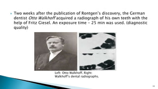  Two weeks after the publication of Rontgen’s discovery, the German
dentist Otto Walkhoff acquired a radiograph of his own teeth with the
help of Fritz Giesel. An exposure time - 25 min was used. (diagnostic
quality)
10
Left: Otto Walkhoff. Right:
Walkhoff’s dental radiographs.
 