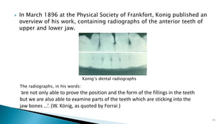  In March 1896 at the Physical Society of Frankfort, Konig published an
overview of his work, containing radiographs of the anterior teeth of
upper and lower jaw.
11
Konig’s dental radiographs
The radiographs, in his words:
“are not only able to prove the position and the form of the fillings in the teeth
but we are also able to examine parts of the teeth which are sticking into the
jaw bones ...’. (W. König, as quoted by Forrai )
 