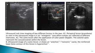 112
Ultrasound real-time imaging of two different lesions in the jaws. A1, Periapical lesion (granuloma)
as seen in the ultrasound image it is an ‘‘echogenic’’ area where echoes are reflected at different
intensities. A2, The same lesion after the application of color power Doppler. The colored spots
represent the vascularization within the lesion.
B, Ultrasound image of a cystic lesion ,it shows an ‘‘anechoic’’/’’transonic’’ cavity; the reinforced
lower bone contour of this lesion is hyperechoic’’ .
 