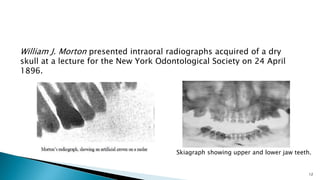 12
Skiagraph showing upper and lower jaw teeth.
William J. Morton presented intraoral radiographs acquired of a dry
skull at a lecture for the New York Odontological Society on 24 April
1896.
 