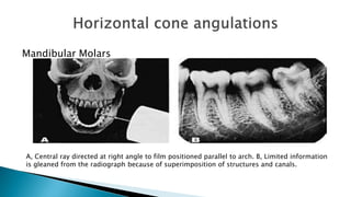 Mandibular Molars
A, Central ray directed at right angle to film positioned parallel to arch. B, Limited information
is gleaned from the radiograph because of superimposition of structures and canals.
 