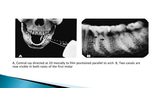 A, Central ray directed at 20 mesially to film positioned parallel to arch. B, Two canals are
now visible in both roots of the first molar
 
