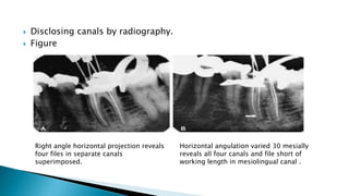  Disclosing canals by radiography.
 Figure
Right angle horizontal projection reveals
four files in separate canals
superimposed.
Horizontal angulation varied 30 mesially
reveals all four canals and file short of
working length in mesiolingual canal .
 