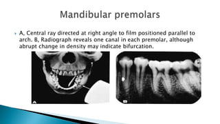  A, Central ray directed at right angle to film positioned parallel to
arch. B, Radiograph reveals one canal in each premolar, although
abrupt change in density may indicate bifurcation.
 
