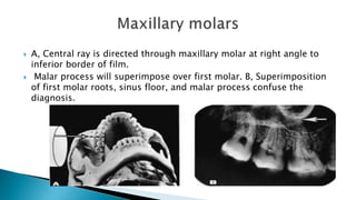  A, Central ray is directed through maxillary molar at right angle to
inferior border of film.
 Malar process will superimpose over first molar. B, Superimposition
of first molar roots, sinus floor, and malar process confuse the
diagnosis.
 