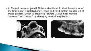  A, Central beam projected 20 from the distal. B, Mesiobuccal root of
the first molar is isolated and second and third molars are cleared of
malar process, which is projected forward . Sinus floor may be
‘‘lowered’’ or ‘‘raised’’ by changing vertical angulation.
 