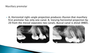  A, Horizontal right-angle projection produces illusion that maxillary
first premolar has only one canal. B, Varying horizontal projection by
20 from the mesial separates two canals. Buccal canal is distal (MBD).
 