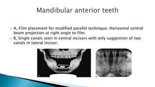  A, Film placement for modified parallel technique. Horizontal central
beam projection at right angle to film.
 B, Single canals seen in central incisors with only suggestion of two
canals in lateral incisor.
 