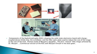  Components of the RadioVisioGraphy (RVG)-showing the solid-state electronics board with charge-
coupled device (CCD) chip, the scintillator, and the fiber optic plate used to reduce the size of the image
to the size of the CCD. Primary tooth of Mouyen’s daughter., The first ‘‘clinical’’ RVG image achieved by
Dr. Mouyen . , Commercial version of the RVG with Mouyen himself in the blue gown.
51
 