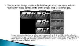  The resultant image shows only the changes that have occurred and
“subtracts“ those components of the image that are unchanged.
Image comparing baseline to follow-up images made at 3, 6, and 12 months following
endodontic therapy . Column 3 indicates subtraction of respective follow-up images from
the baseline radiograph. Progressive remineralization of the radiolucency at the apex of
the distal root of the first molar .
 