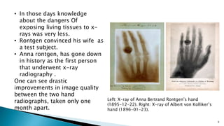 9
Left: X-ray of Anna Bertrand Rontgen’s hand
(1895-12-22). Right: X-ray of Albert von Kolliker’s
hand (1896-01-23).
• In those days knowledge
about the dangers Of
exposing living tissues to x-
rays was very less.
• Rontgen convinced his wife as
a test subject.
• Anna rontgen, has gone down
in history as the first person
that underwent x-ray
radiography .
One can see drastic
improvements in image quality
between the two hand
radiographs, taken only one
month apart.
 